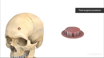 Skull Fracture - 3D animation