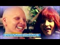 Jovem com alopecia passa por transformação no visual