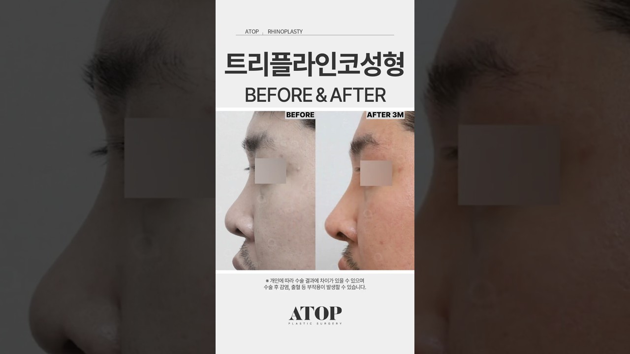 [Эйтоп гоо сайхны мэс заслын эмнэлэг] Эрэгтэй хамарны мэс засал хийлгэснээс 3 сарын дараа, огт өөр хүн болсон.