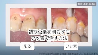 虫歯の意外な事実 現役歯医者があなたに指摘する虫歯の原因と対処法