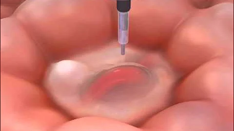 NEJM Procedure: Endoscopic Management of Acute Bleeding from a Peptic Ulcer