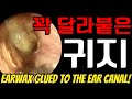 EP.178 꽉 달라붙은 귀지 (EARWAX GLUED TO THE EAR CANAL!!)