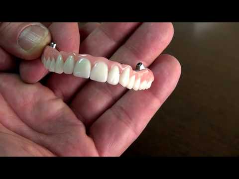 dental-implants-by-dr.-sean-mohtashami-of-all-bright-dental