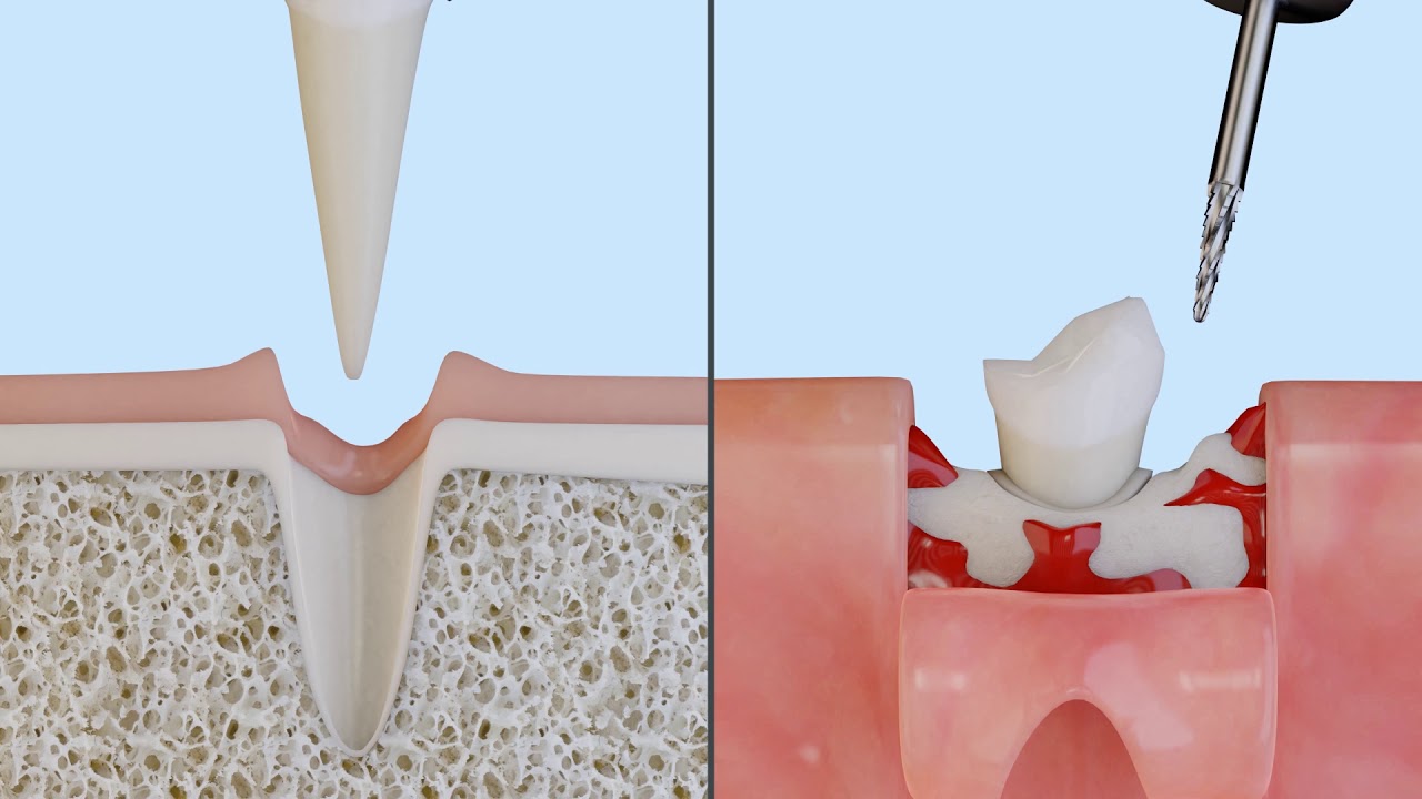 TUTORIAL 3D Piezo VS Rotative Implanto – Instrumentation – Acteon Group