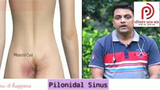 Pilonidal sinus पिलोनाइडल साइनस का अयुर्वेदिक इलाज 100% गारंटी के साथ- Dr. Kamal Mittal जी से सुनिए