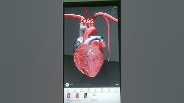 coronary artery bypass,heart,surgery,bypass grafting,open heart surgery,heart bypass,heart operation