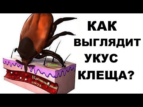 Как выглядит укус клеща и что делать при укусе?