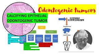 Calcifying Epithelial Odontogenic Tumor Ceotdetailedpindborg Tumor Tumors Of Odontogenic Origin