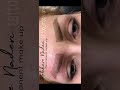 Tattoo Removal ریموو تتو Tattoo Removal ریموو تتو