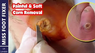 The Most Painful & Soft Corn On Pinky TOE | Remove Painful Old Corn From Feet screenshot 5