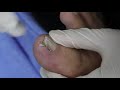 Ep_2026 Toenail removal 👣 ทรงเล็บ..ทำไมเปลี่ยน?   😷 (This clip is from Thailand)