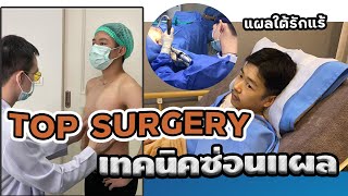 Transtender Ep.18 l รีวิวตัดหน้าอกแบบส่องกล้อง ไร้รอยแผล ซ่อนแผลใต้รักแร้ FTM Surgery Eng sub