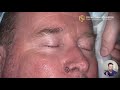 Nose reconstruction with a full thickness skin graft