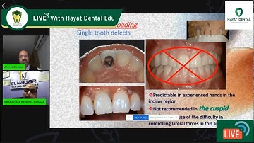 loading protocols for dental implants, , immediate loading part 1