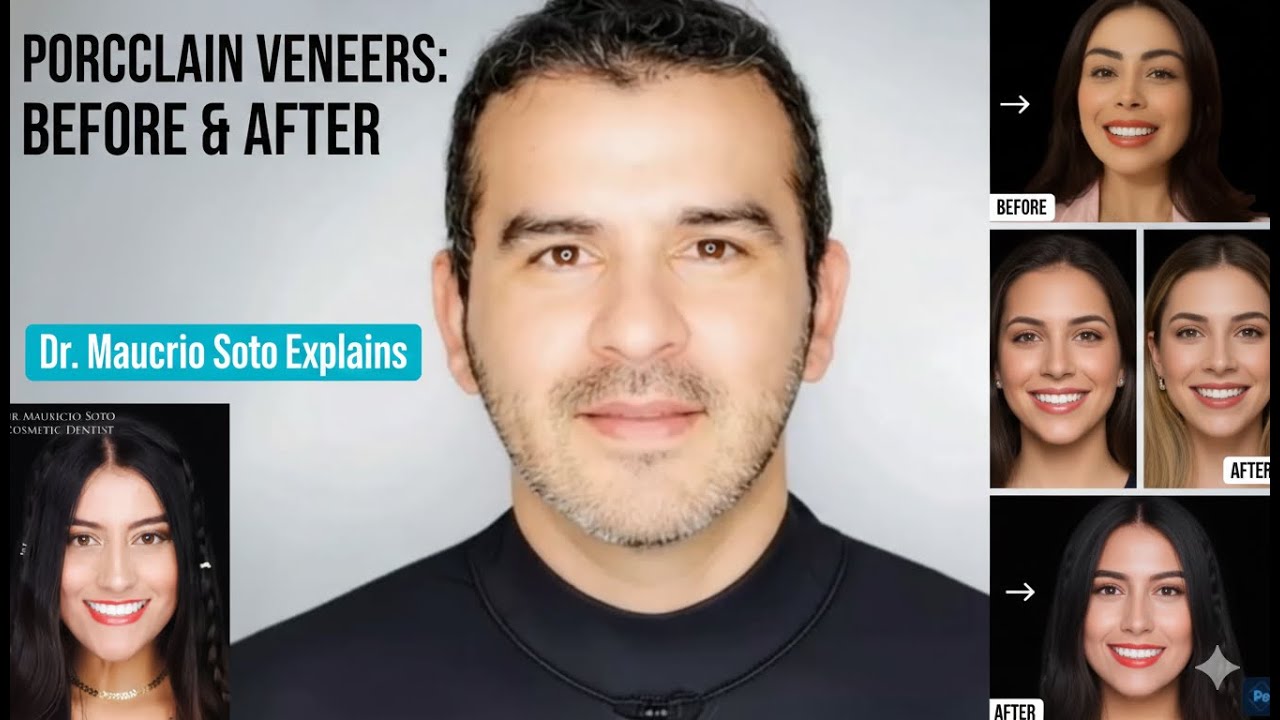 Всё, что вам нужно знать о фарфоровых винирах (прежде чем их установить!)