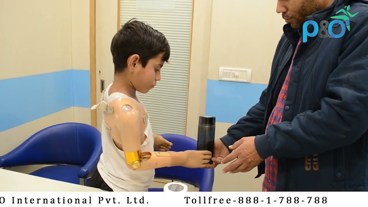 Bilateral Above Elbow | Myo-electric | P&O International Limb Center