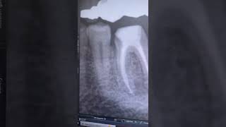 Non surgical Root canal re treatment of first molar #cadcam #dental #endodontic