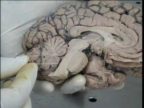 4 ventriculo - YouTube 4 ventriculo - YouTube