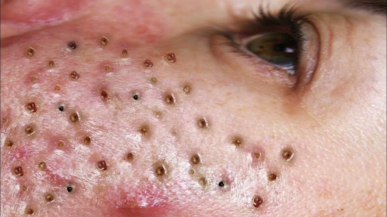 Ga Spa Videos For Removal Of Blackheads Sac Dep Spa Blackhead's Removed On Nose | Sac dep spa blackheads | spa