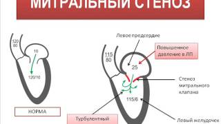 Стеноз митрального клапана