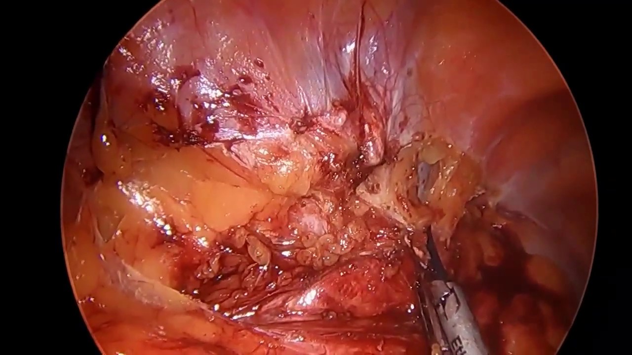 Litíase biliar e aderências / Biliary lithiasis and adhesions doutor estranho filme