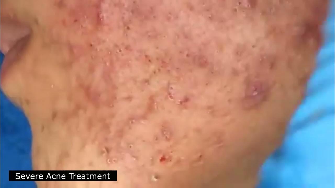 BEST BLACKHEAD AND WHITEHEAD REMOVAL! SEVERE ACNE TREATMENT