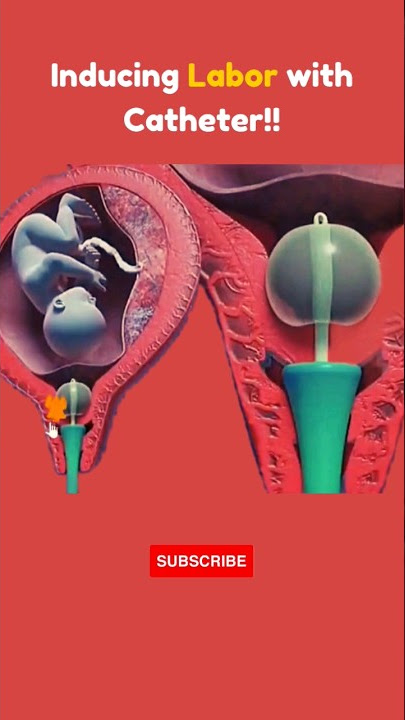 Induction Process #shorts #share #pregnancy #foryou