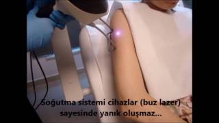 Lazer Epilasyon Uygulaması
