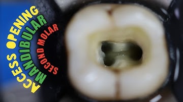 access opening in mandibular second molar | Biomechanical Preparation | Rotary Endodontics