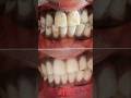 Composite veneers |Before and After #smiledesigndental #composite #smilemakeover #shortsfeed #fyp