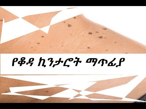 ቪዲዮ: ኪንታሮት በልጆች ላይ እንዴት እንደሚታከም