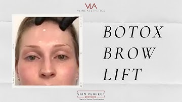 Treating BOTOX BROW LIFT with Botox | Skin Perfect Walnut Medical Spa Clinic