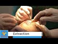 Fue hair transplant complete procedure  maxwell hospital