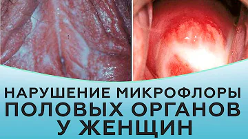 Нарушение микрофлоры половых органов у женщин