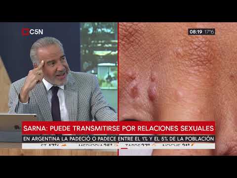 Vídeo: ¿Es La Sarna Una ETS? Cómo Lo Obtienes Y Cuánto Tiempo Es Contagioso