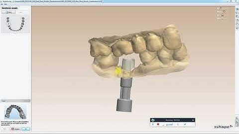 How to design a Digital Implant Model in 3Shape
