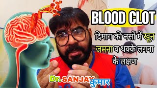Blood clot in brain symptoms in hindi | Dimag ki naso me khoon jamna (brain blood clot symptoms)