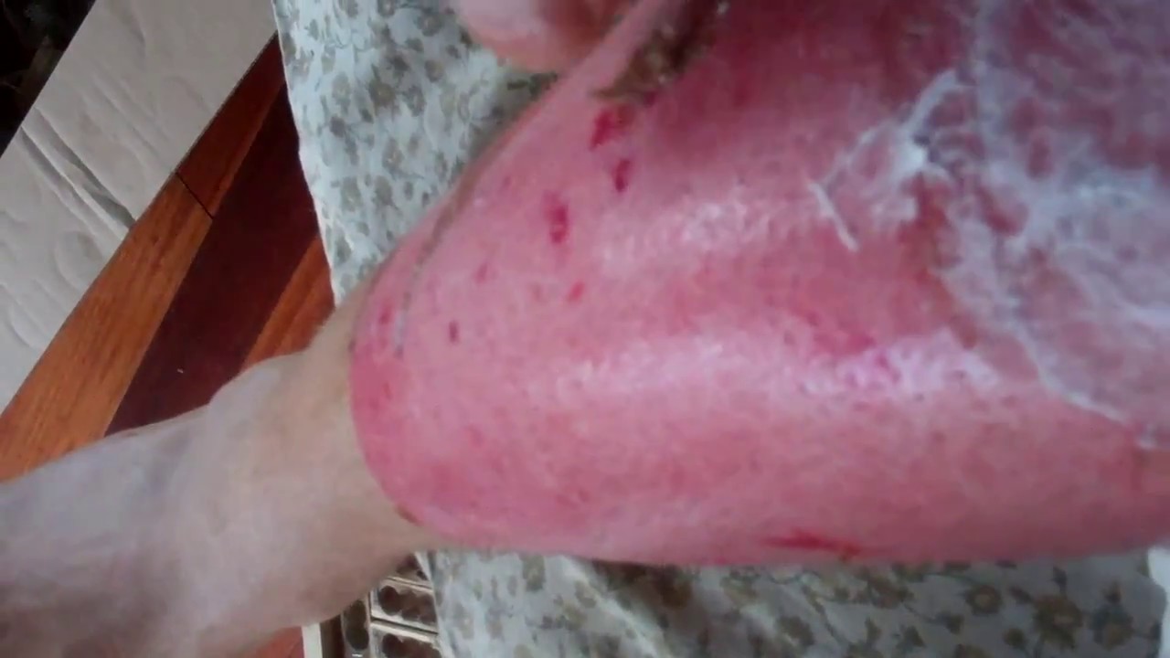 Peeling off skin after a burn to avoid massive infection ...