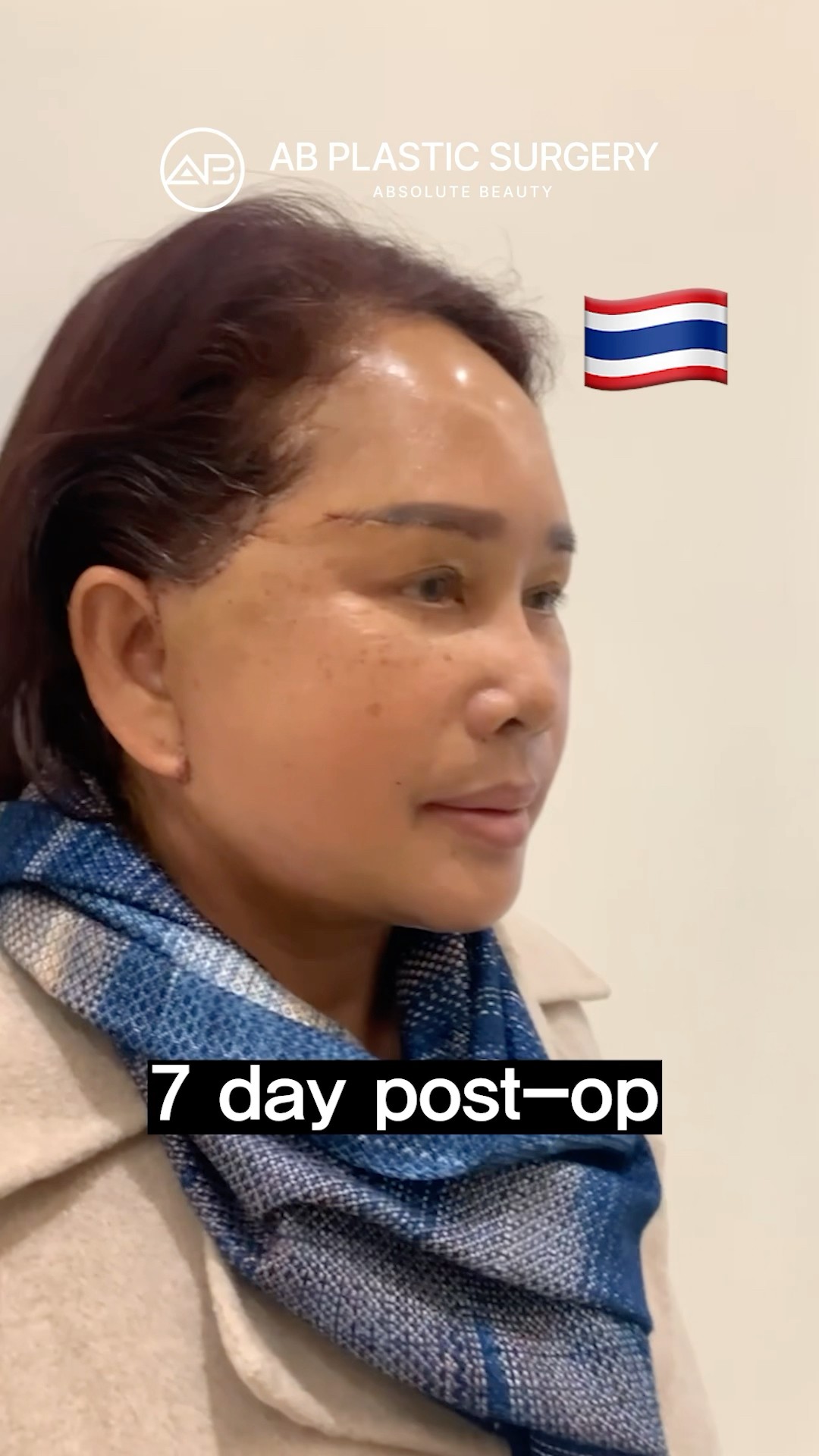 This Facelift Made Her Look Decades Younger #shorts
