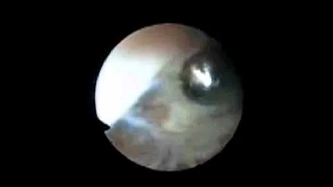 Arthrofibrosis of the Ankle | Arthrofibrotic Tissue Removal | Simon Moyes Capital Orthopaedics