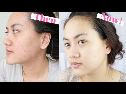 BANTU PUDAR KAN BEKAS JERAWAT - Updated Acne Skincare Routine + Praktek Pemakaian