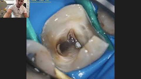 Dental MacGyver - Tips & Tricks e3 (en): Cutting a wooden wedge to the shape of the cavity