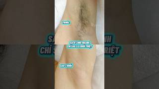 Bạn sẽ nhận được gì khi triệt lông Diodelaser Ruby AI? #svietspa #beauty #spauytinhanoi #lamdep