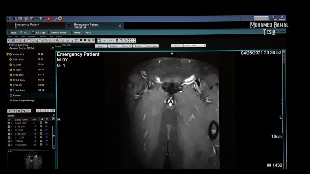 MRI FISTULOGRAPHY   فحص الناسور الشرجي بالرنين المغناطيسي