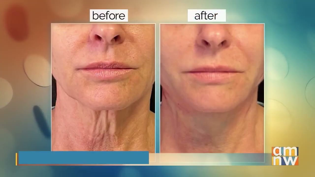 The MiniFaceLift: Look 10 years younger in just a day with very little downtime