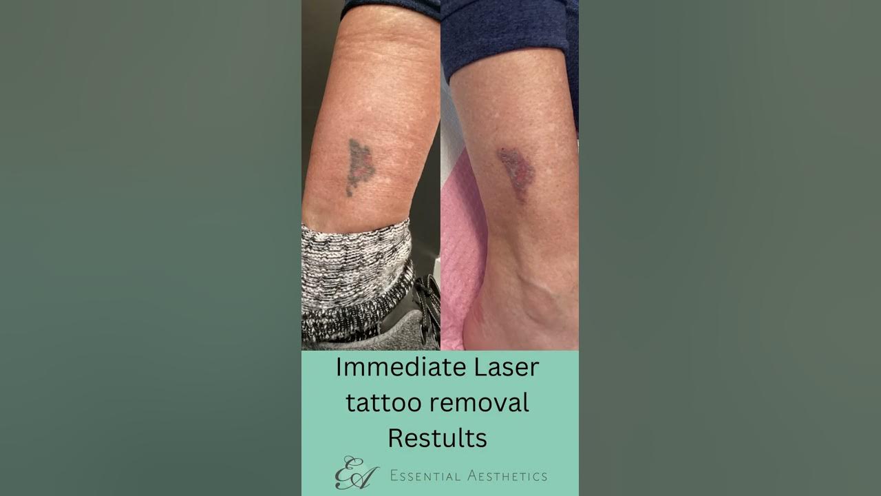 Laser Tattoo Removal YouTube