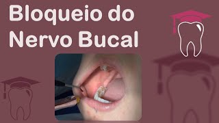 Lingual nervo prognóstico do dano do