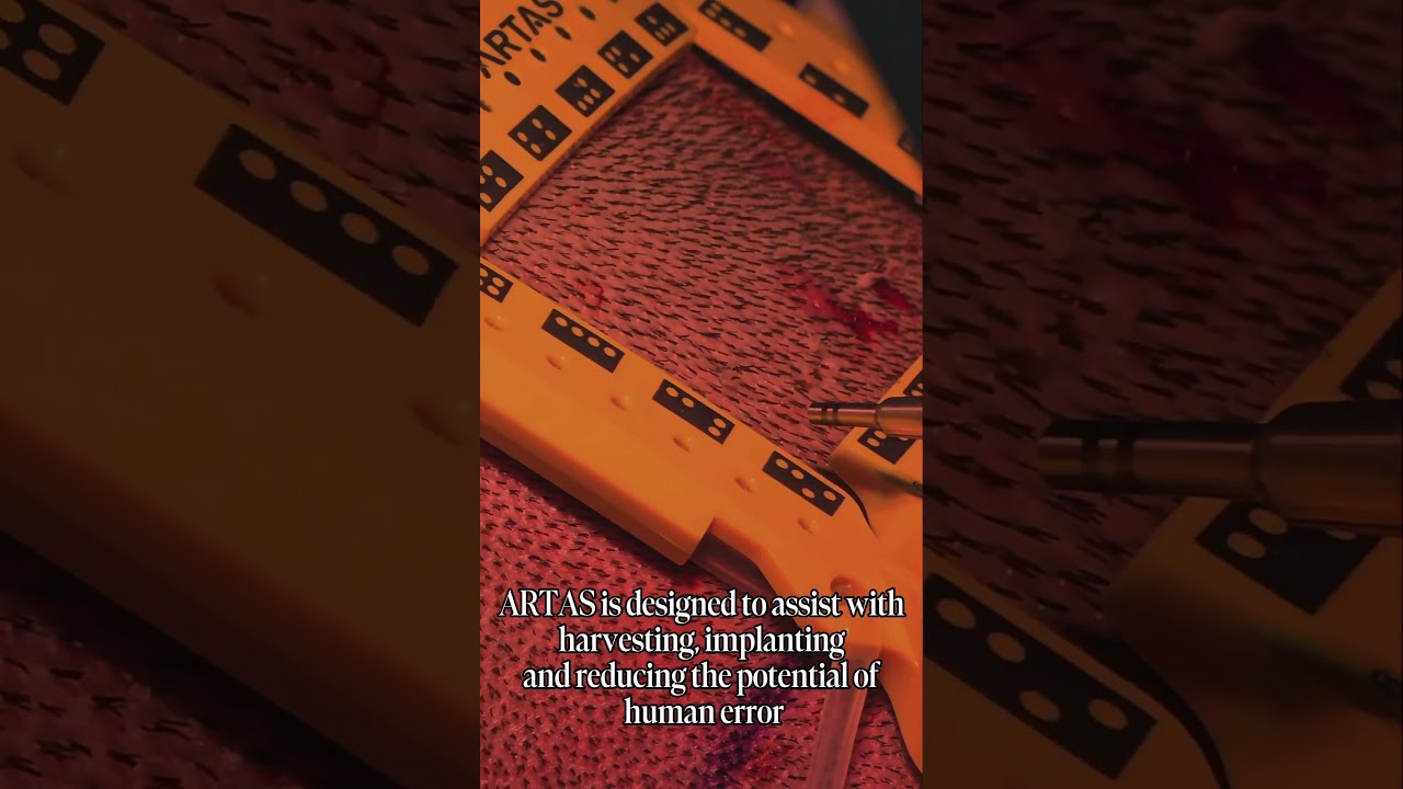 ARTAS: AI-powered robotic hair transplant. Dr. Max delivers precision & natural results 