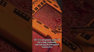 Artas Ai-Powered Robotic Hair Transplant. Dr. Max Delivers Precision & Natural Results