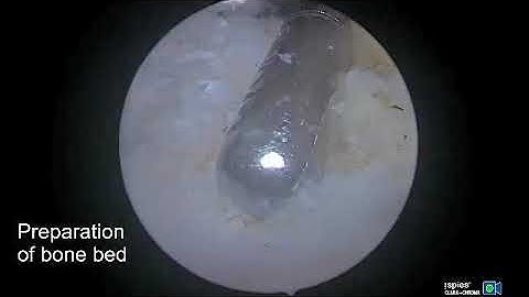 Arthroscopic Subscapularis Repair Through a Single Anterior Portal